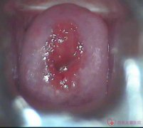 宮頸糜爛是什么樣子的？宮頸糜爛的圖片
